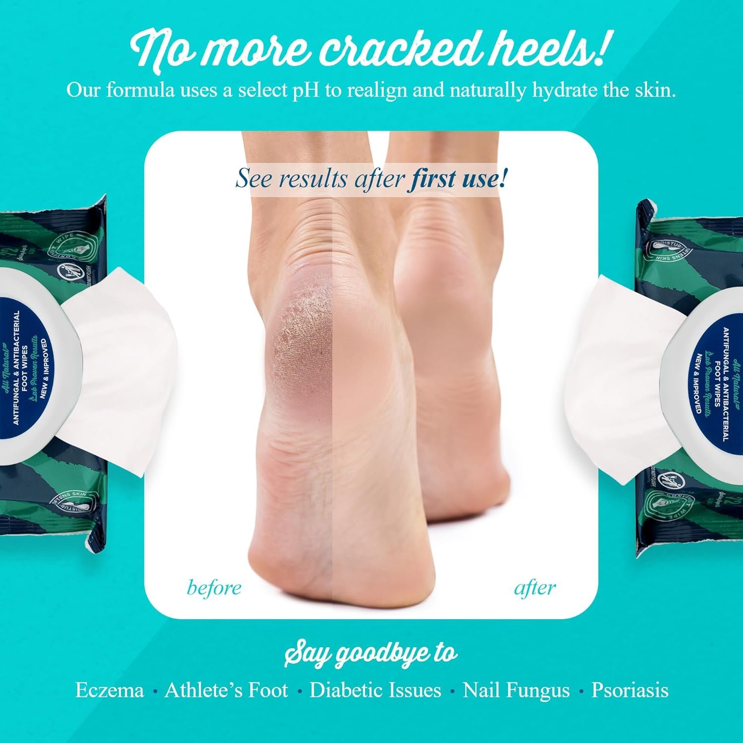 pHeet® Foot Wipes All-Natural Antifungal & Antibacterial Formula, Cleanses, Moisturizes, Prevents & Kills Athletes Foot, Toenail & Foot Fungus, Odor & Improves Dry, Cracked, Flaky & Diabetic Skin 72ct - Image 4