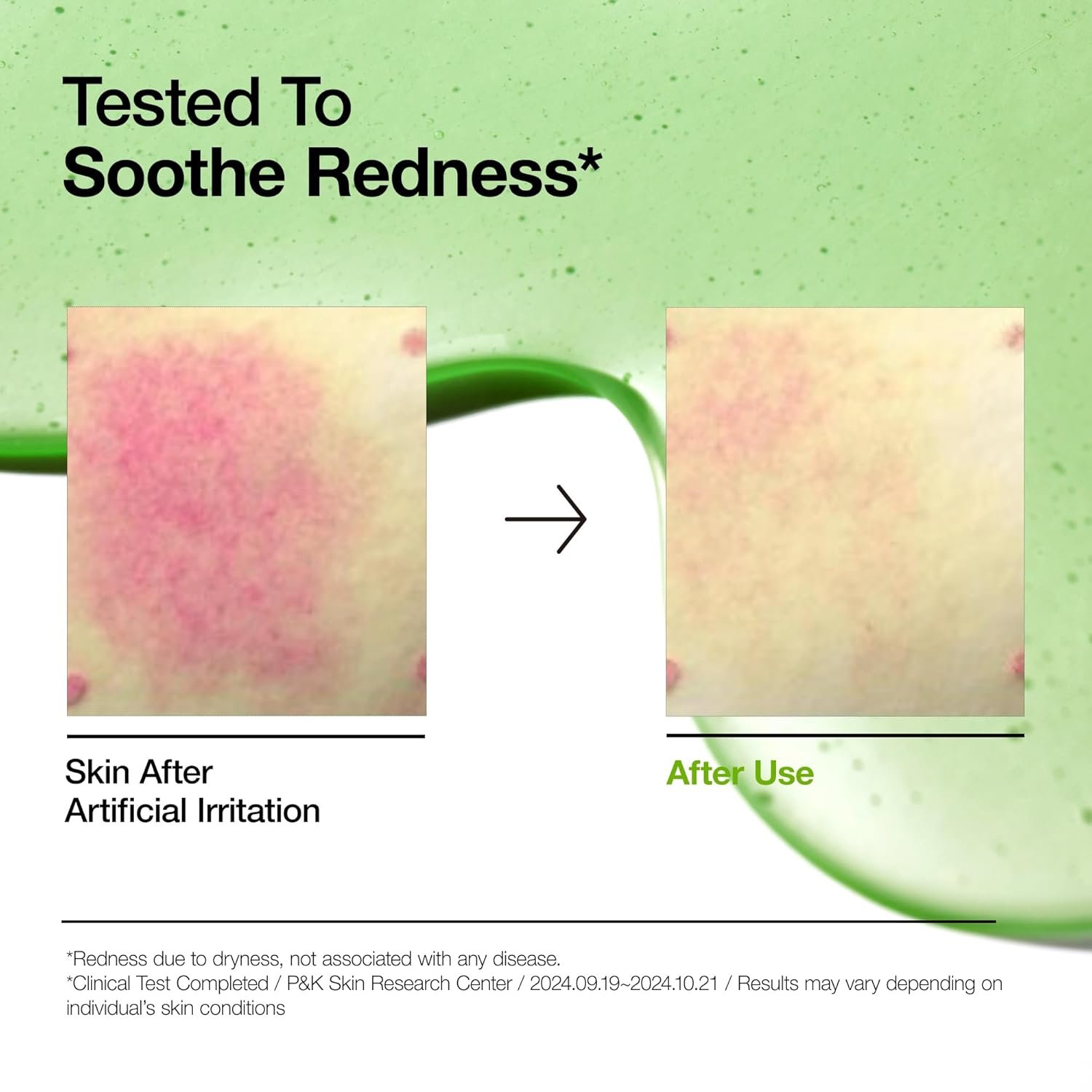 Anua Azelaic Acid 10 Hyaluron Redness Soothing Serum, Facial Serum for Troubled & Sensitive Skin, Breakouts, Hyaluronic Acid, Niacinamide, Spot Care, Natural Color, Korean Skincare (30ml/ 1.01 fl oz.) - Image 4